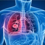 tuberculose